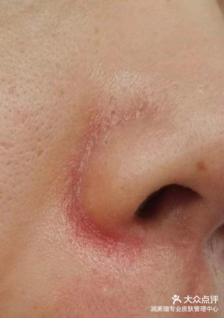 鼻翼两边经常红红的有时候还有点皮屑还有点痒该咋整