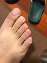 -德哥灰指甲脚气甲沟炎跖疣护理
