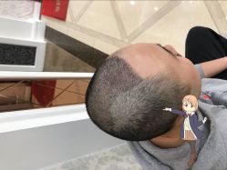 -大麦微针植发丨全国连锁