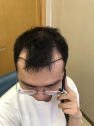 -大麦微针植发全国连锁