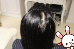 -大麦微针植发丨全国连锁