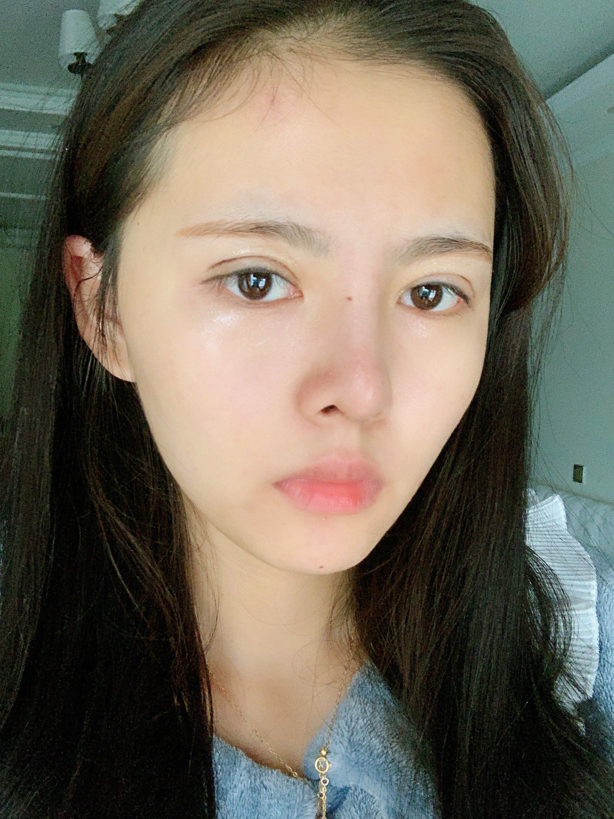 【眼部综合6项】体验90天后效果分享