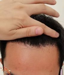 -大麦微针植发丨全国连锁