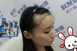 点击看大图 -大麦微针植发丨全国连锁