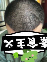 -大麦微针植发丨全国连锁
