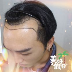 -大麦微针植发全国连锁