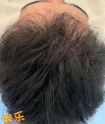 -大麦微针植发丨全国连锁