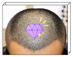 -大麦微针植发全国连锁