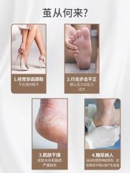 -德哥灰指甲脚气甲沟炎跖疣护理