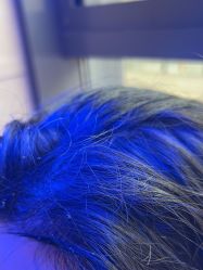 -碧莲盛·不剃发植发