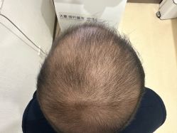 -大麦微针植发丨全国连锁