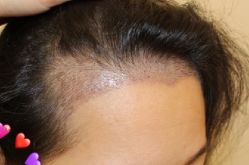 -大麦微针植发丨全国连锁