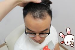 -大麦微针植发丨全国连锁