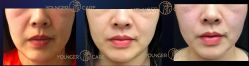 -HYOUNG 禾漾·BTL官方美学中心