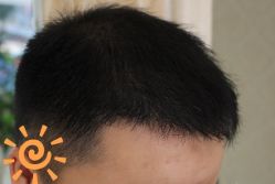 -大麦微针植发丨全国连锁