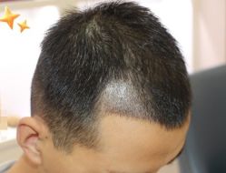 -大麦微针植发丨全国连锁