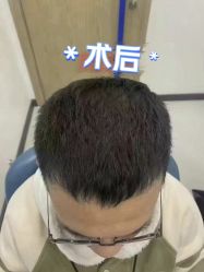 -大麦微针植发丨全国连锁