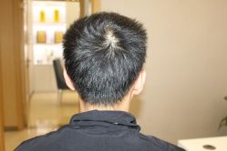 -大麦微针植发丨全国连锁