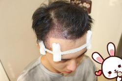 -大麦微针植发丨全国连锁