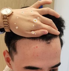 -大麦微针植发丨全国连锁