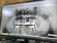 -上海仁爱医院口腔科 · 种植