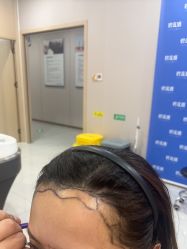 -碧莲盛不剃发植发