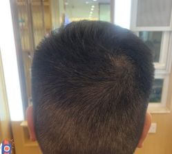 -大麦微针植发丨全国连锁