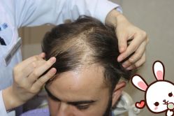 点击看大图 -大麦微针植发丨全国连锁