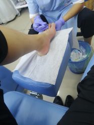 -德哥灰指甲脚气甲沟炎跖疣护理