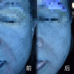 体验前-柠檬一美·Ondapro·轻薄紧致抗衰中心