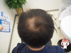 -大麦微针植发丨全国连锁