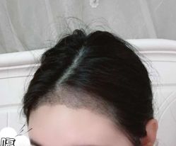 -大麦微针植发丨全国连锁