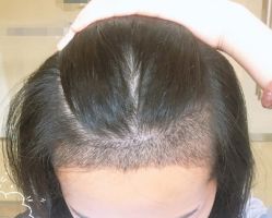 -大麦微针植发丨全国连锁