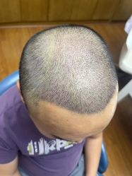 -大麦微针植发全国连锁