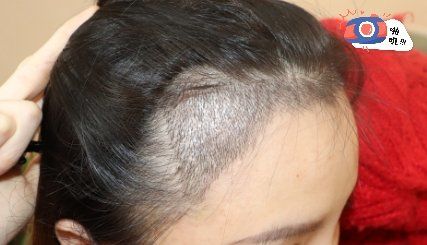 -大麦微针植发丨全国连锁