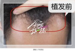 -大麦微针植发全国连锁