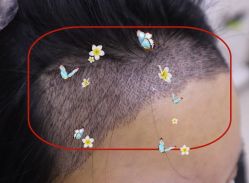 -大麦微针植发全国连锁