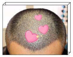 -大麦微针植发全国连锁