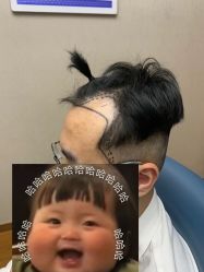 -大麦微针植发全国连锁