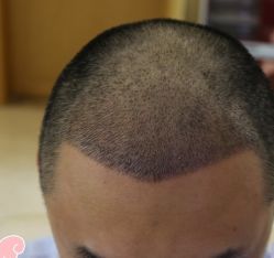 -大麦微针植发丨全国连锁