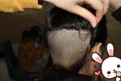 点击看大图 -大麦微针植发丨全国连锁