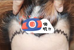 -大麦微针植发全国连锁