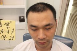 点击看大图 -大麦微针植发丨全国连锁