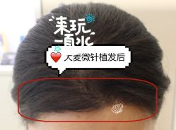 -大麦微针植发全国连锁