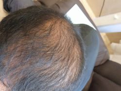 -碧莲盛·不剃发植发