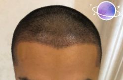 -大麦微针植发丨全国连锁