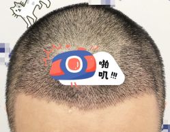 -大麦微针植发全国连锁