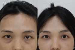 -广州健丽·去眼袋医疗美容机构