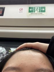 体验后-悟空祛痘·诺奖技术专业店