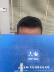 点击看大图 -大麦微针植发丨全国连锁